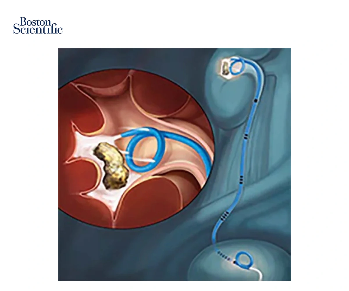 Стент мочеточниковый универсальной длины CONTOUR VL INJECTION