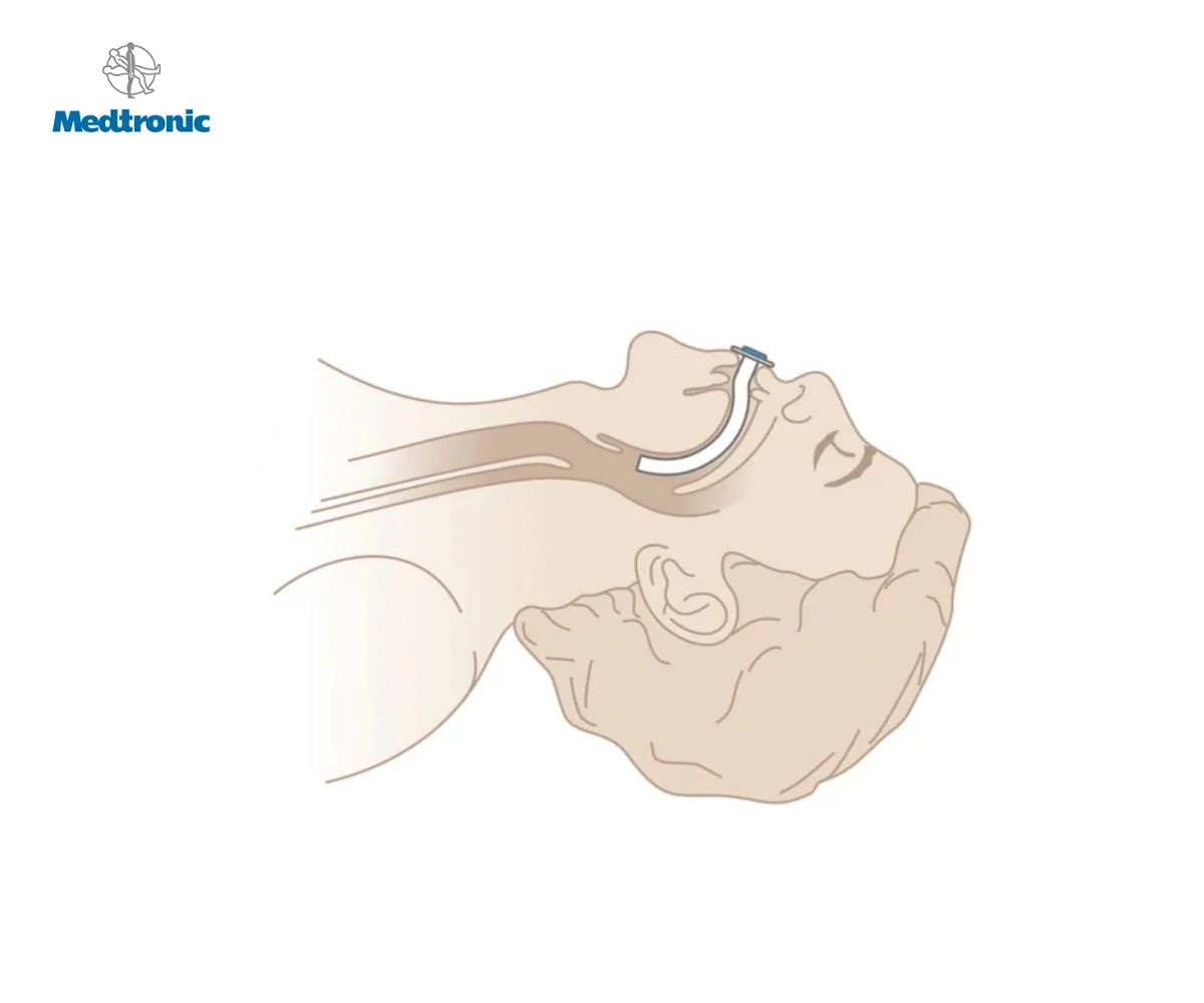 Воздуховоды орофарингеальные (гведела) MEDTRONIC