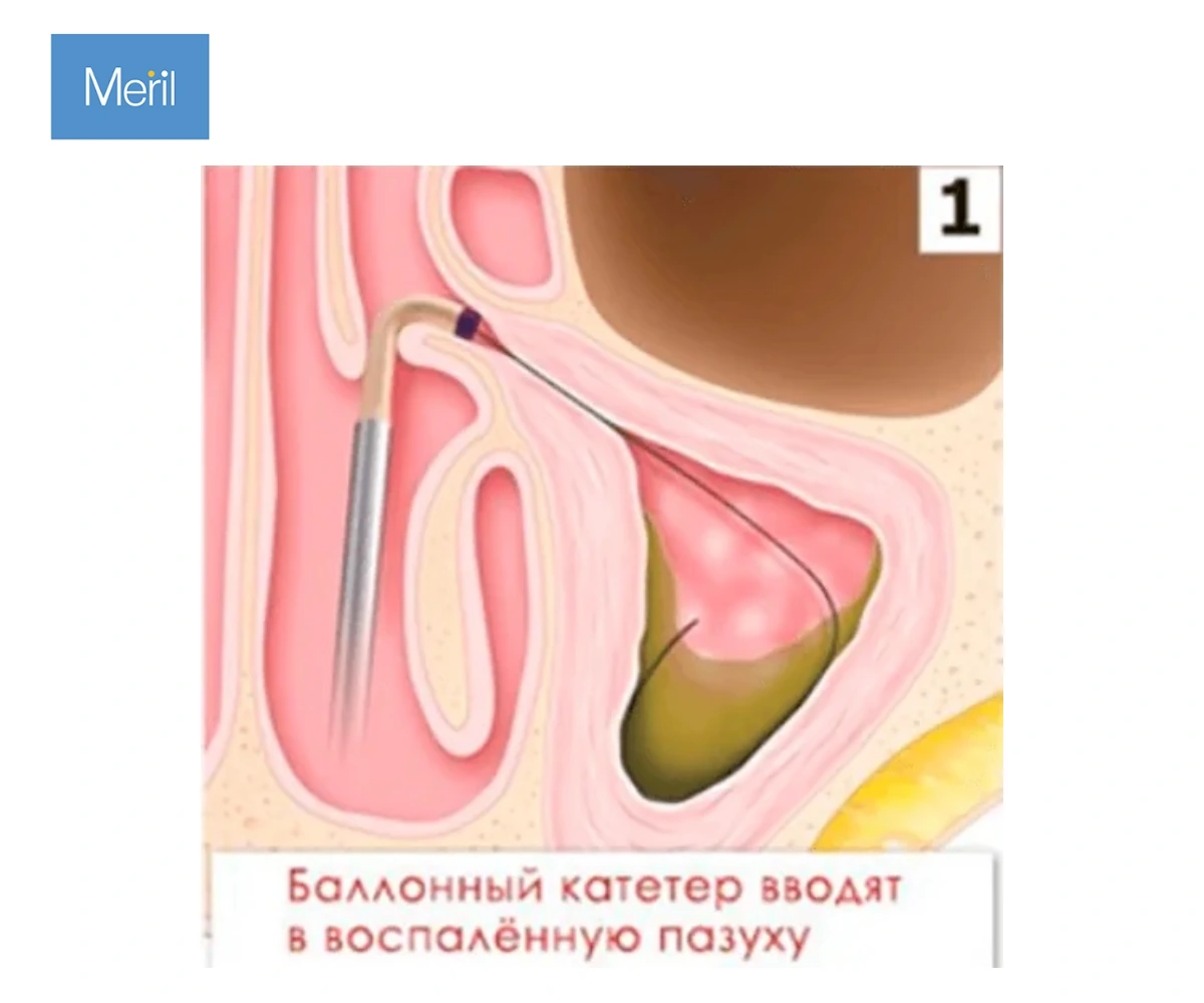 Катетер проводниковый MESIRE