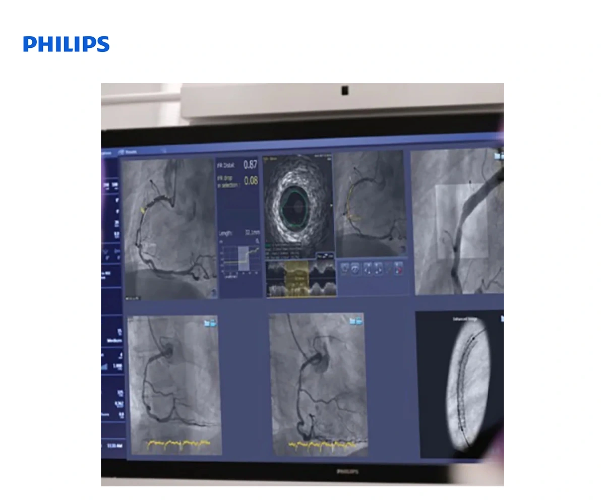 PHILIPS SYNCVISION: система ко-регистрации всузи и физиологии