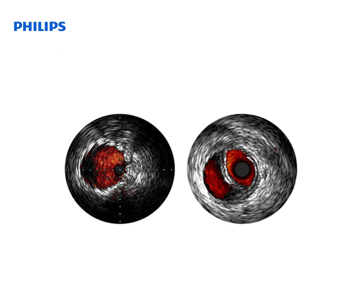 PHILIPS EAGLE EYE: цифровые катетеры для всузи периферии
