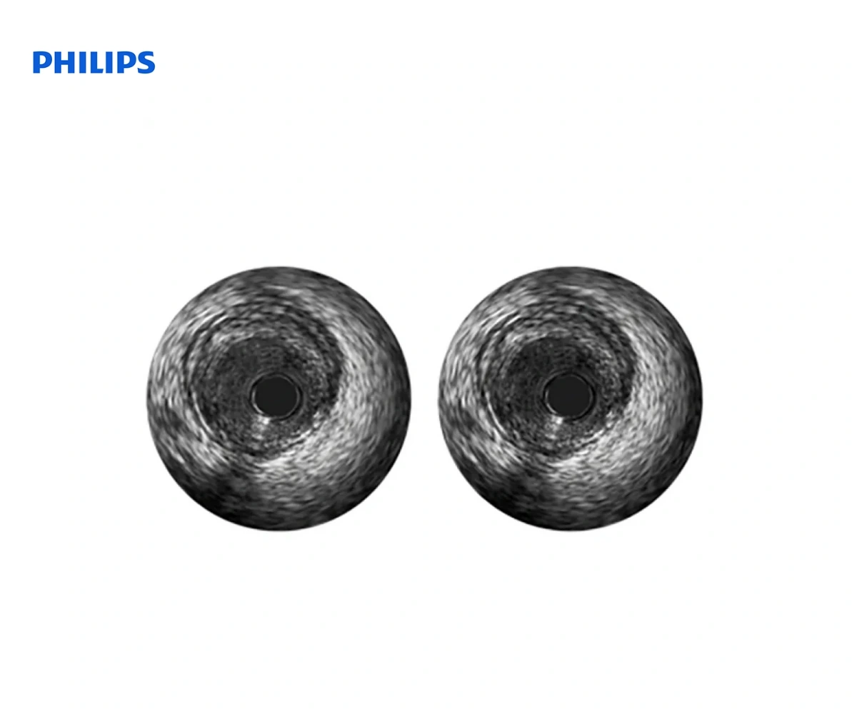 PHILIPS REFINITY: ротационный катетер для всузи