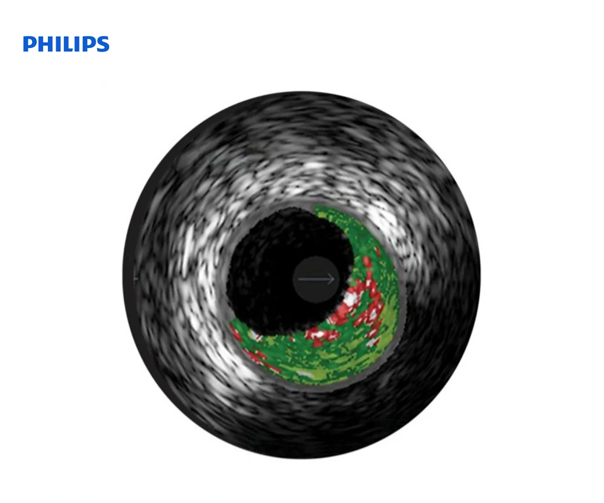 PHILIPS VH IVUS: режим виртуальной гистологии всузи