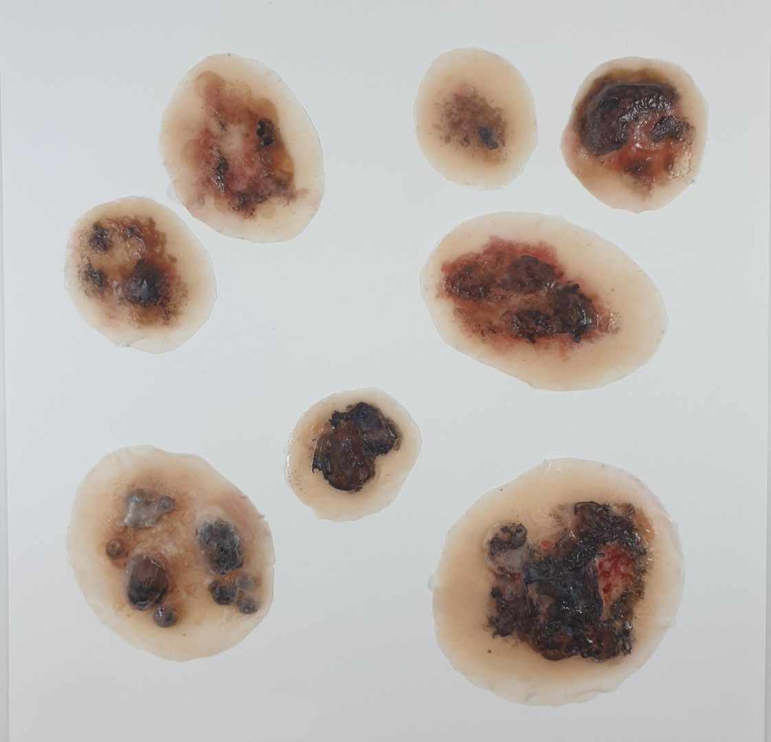 Комплект накладных муляжей: меланомы